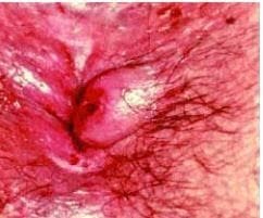 Piles Treatment Near Naini Prayagraj